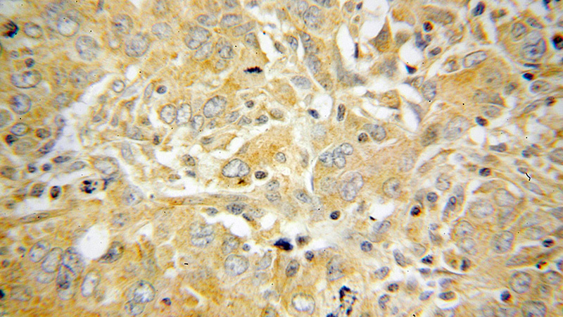 Immunohistochemical of paraffin-embedded human breast cancer using Catalog No:113560(p70(S6K) antibody) at dilution of 1:100 (under 40x lens)