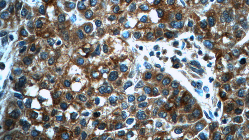 Immunohistochemistry of paraffin-embedded human liver cancer tissue slide using Catalog No:115093(SCT Antibody) at dilution of 1:50 (under 40x lens)