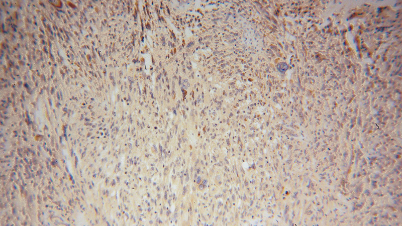 Immunohistochemical of paraffin-embedded human gliomas using Catalog No:115545(Spartin, SPG20 antibody) at dilution of 1:100 (under 10x lens)