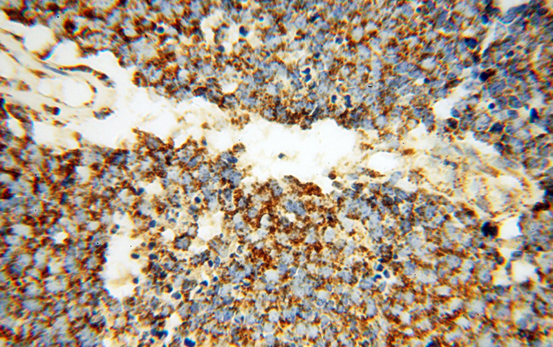 Immunohistochemical of paraffin-embedded human lung cancer using Catalog No:111567(HSPD1 antibody) at dilution of 1:100 (under 40x lens)