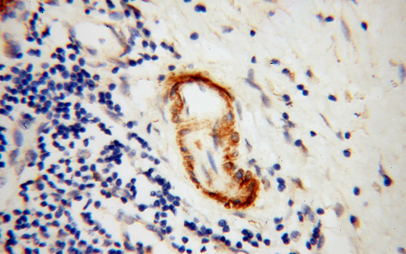 Immunohistochemical of paraffin-embedded human pancreas cancer using Catalog No:108004(AMPH antibody) at dilution of 1:100 (under 40x lens)