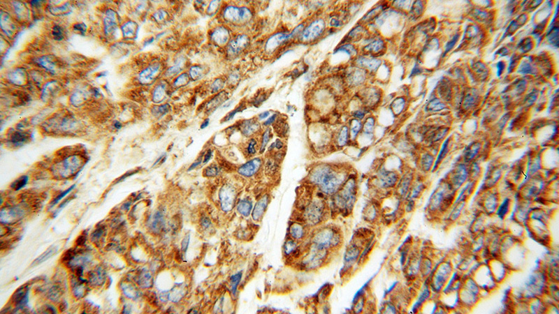 Immunohistochemical of paraffin-embedded human lung cancer using Catalog No:110375(PDIA4 antibody) at dilution of 1:100 (under 40x lens)