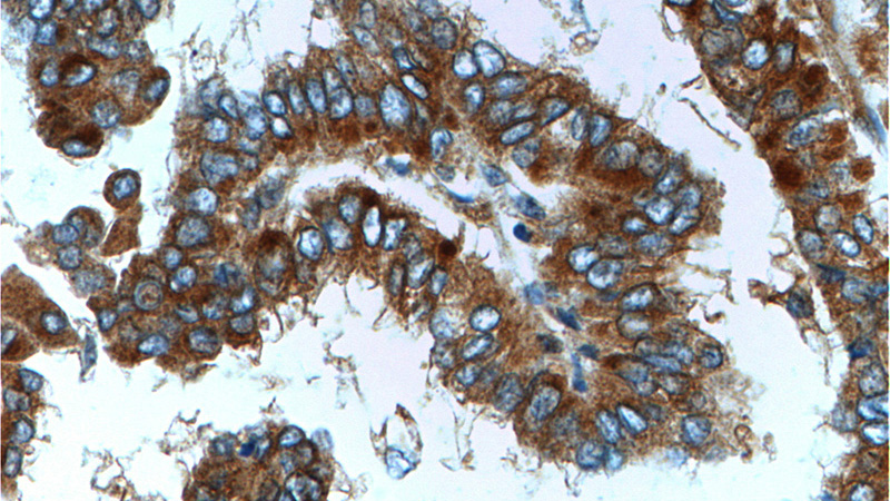 Immunohistochemistry of paraffin-embedded human thyroid cancer tissue slide using Catalog No:113846(PRKCA Antibody) at dilution of 1:200 (under 40x lens).