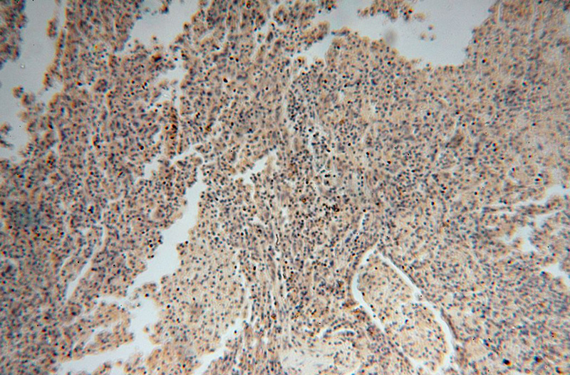 Immunohistochemical of paraffin-embedded human lung cancer using Catalog No:109831(DDX43 antibody) at dilution of 1:100 (under 10x lens)
