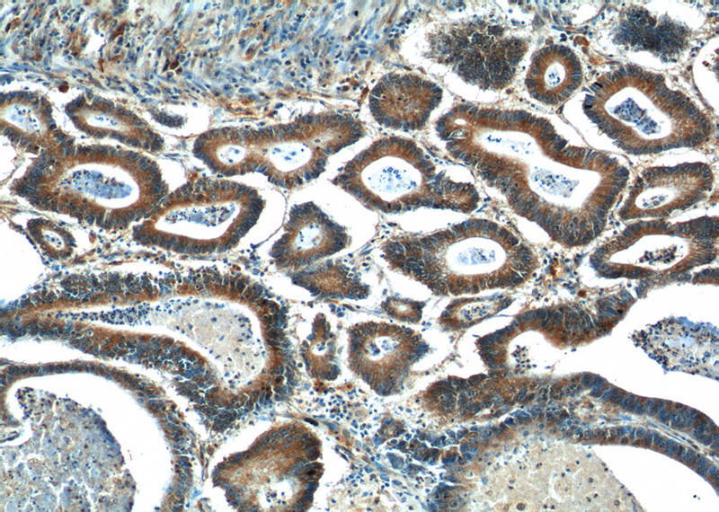 Immunohistochemistry of paraffin-embedded human colon cancer tissue slide using Catalog No:117103(BCL7B Antibody) at dilution of 1:50 (under 10x lens)