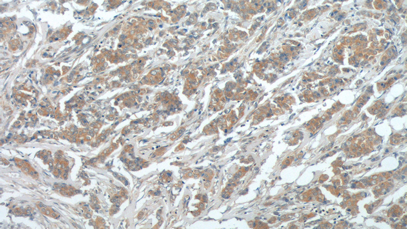 Immunohistochemistry of paraffin-embedded human breast cancer tissue slide using Catalog No:116592(USP15 Antibody) at dilution of 1:200 (under 10x lens).