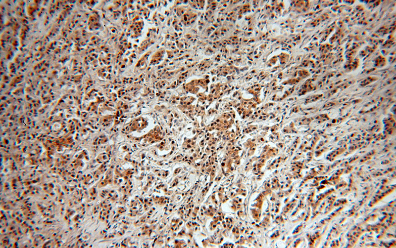 Immunohistochemical of paraffin-embedded human breast cancer using Catalog No:116603(USP28 antibody) at dilution of 1:50 (under 10x lens)