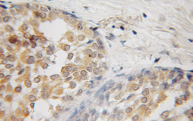 Immunohistochemical of paraffin-embedded human breast cancer using Catalog No:110394(EPS8 antibody) at dilution of 1:50 (under 10x lens)