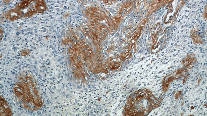 Immunohistochemical of paraffin-embedded human gliomas using Catalog No:108280(ATXN2 antibody) at dilution of 1:50 (under 10x lens)