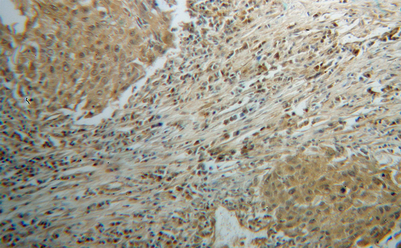 Immunohistochemical of paraffin-embedded human lung cancer using Catalog No:109351(CLEC1A antibody) at dilution of 1:100 (under 10x lens)