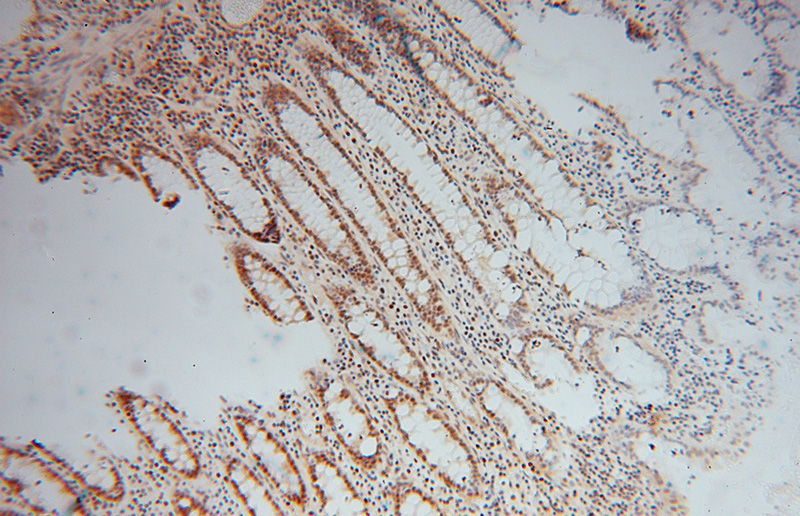 Immunohistochemical of paraffin-embedded human colon cancer using Catalog No:116513(UBE1 antibody) at dilution of 1:50 (under 10x lens)