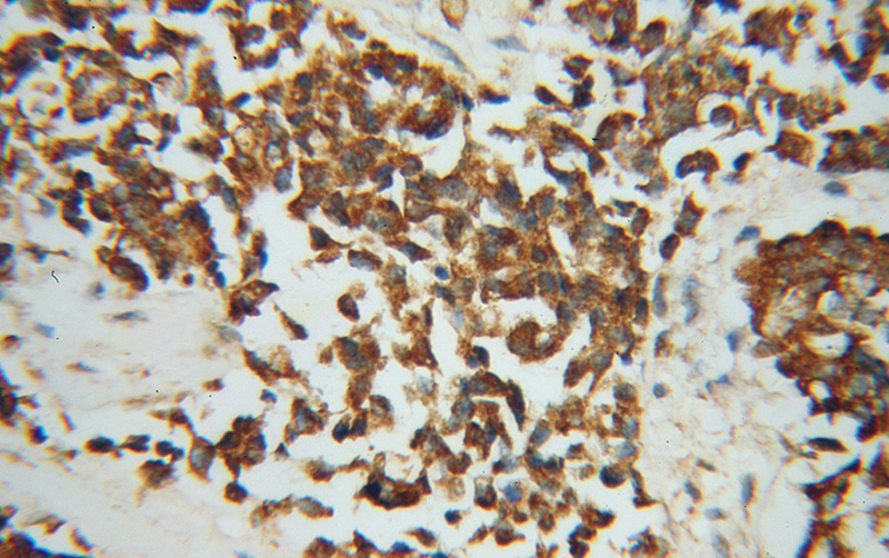 Immunohistochemical of paraffin-embedded human breast cancer using Catalog No:113740(PCK2 antibody) at dilution of 1:100 (under 40x lens)