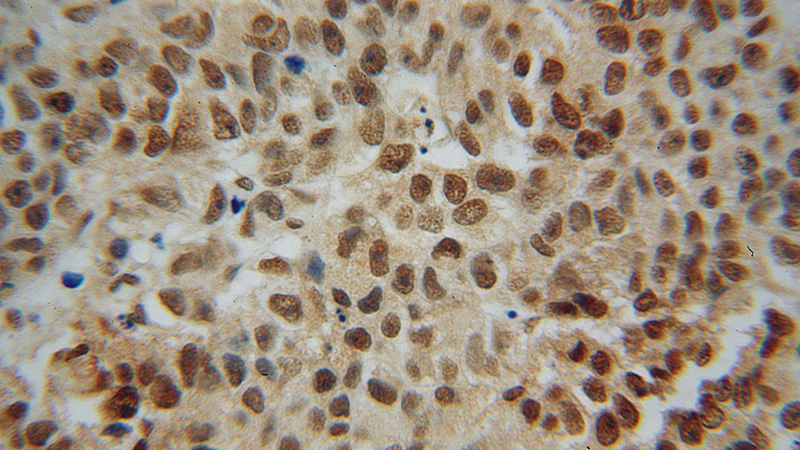 Immunohistochemical of paraffin-embedded human prostate cancer using Catalog No:113266(NR2E3 antibody) at dilution of 1:100 (under 40x lens)