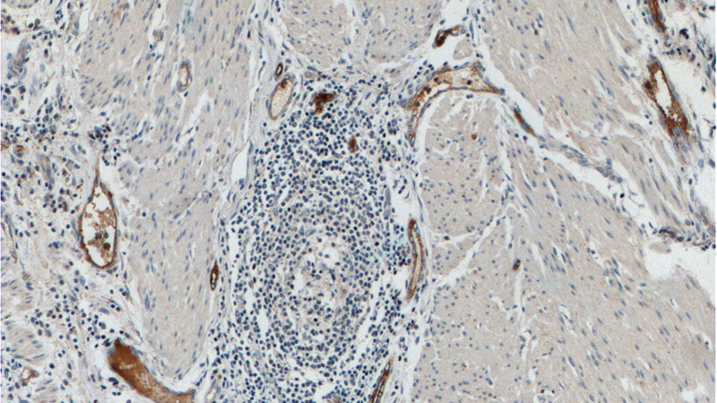 Immunohistochemistry of paraffin-embedded human colon cancer tissue slide using Catalog No:115943(ANTXR1 Antibody) at dilution of 1:200 (under 10x lens).