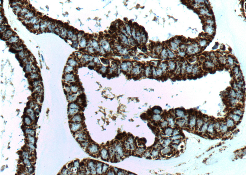 Immunohistochemistry of paraffin-embedded human ovary tumor tissue slide using Catalog No:107266(HSPD1 Antibody) at dilution of 1:500 (under 40x lens). heat mediated antigen retrieved with Tris-EDTA buffer(pH9).