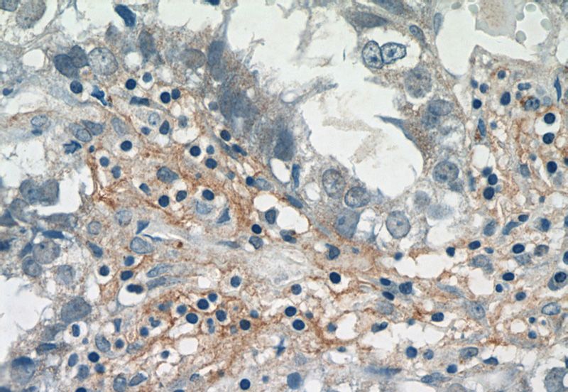 Immunohistochemistry of paraffin-embedded human breast cancer tissue slide using Catalog No:114241(PRR13 Antibody) at dilution of 1:50 (under 40x lens)
