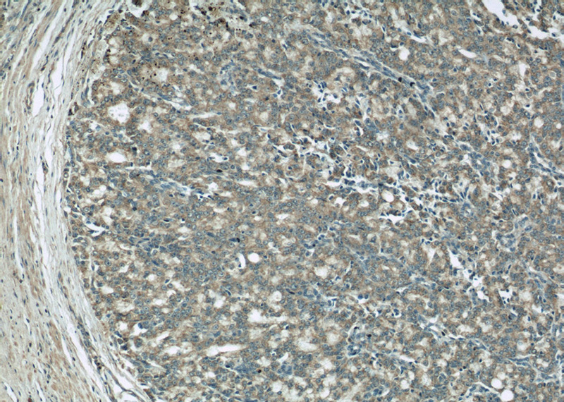 Immunohistochemical of paraffin-embedded human prostate cancer using Catalog No:117311(COXIV antibody) at dilution of 1:100 (under 10x lens)