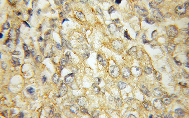 Immunohistochemical of paraffin-embedded human lung cancer using Catalog No:114470(RARRES3 antibody) at dilution of 1:50 (under 10x lens)