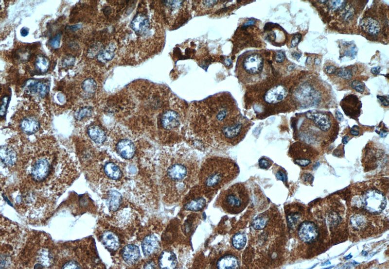 Immunohistochemistry of paraffin-embedded human liver cancer tissue slide using Catalog No:108561(C10orf125 Antibody) at dilution of 1:50 (under 40x lens)