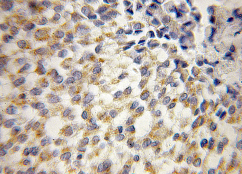 Immunohistochemical of paraffin-embedded human breast cancer using Catalog No:116638(UQCRH antibody) at dilution of 1:50 (under 10x lens)