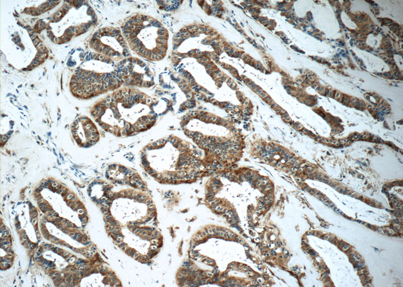 Immunohistochemistry of paraffin-embedded human breast cancer tissue slide using Catalog No:111009(GNPDA2 Antibody) at dilution of 1:50 (under 10x lens)