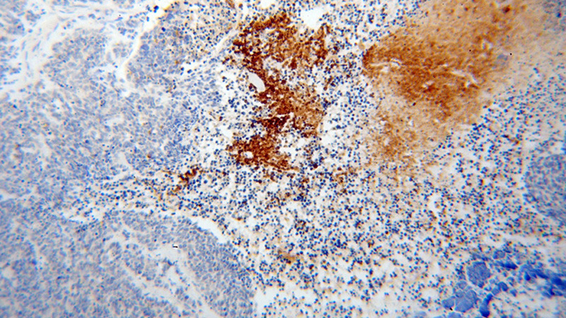 Immunohistochemical of paraffin-embedded human lung cancer using Catalog No:111818(IPO11 antibody) at dilution of 1:100 (under 10x lens)