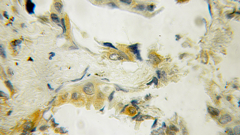 Immunohistochemical of paraffin-embedded human lung cancer using Catalog No:116670(UBXN11 antibody) at dilution of 1:100 (under 10x lens)