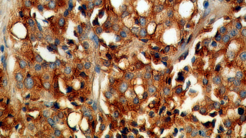 Immunohistochemical of paraffin-embedded human prostate cancer using Catalog No:107738(ACPP antibody) at dilution of 1:50 (under 40x lens)