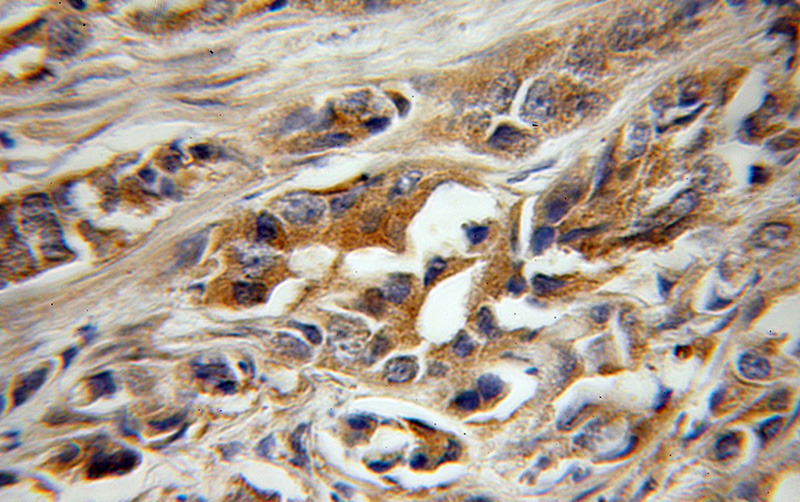 Immunohistochemical of paraffin-embedded human prostate cancer using Catalog No:116849(LAT2 antibody) at dilution of 1:50 (under 10x lens)