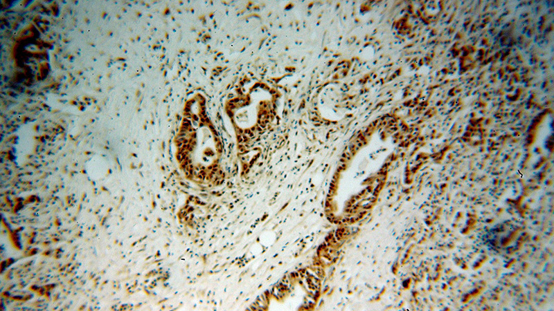 Immunohistochemical of paraffin-embedded human pancreas cancer using Catalog No:114817(RPL17 antibody) at dilution of 1:100 (under 10x lens)