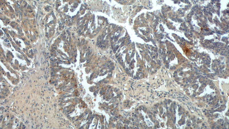 Immunohistochemistry of paraffin-embedded human ovary tumor tissue slide using Catalog No:111905(KLK8 Antibody) at dilution of 1:200 (under 10x lens).