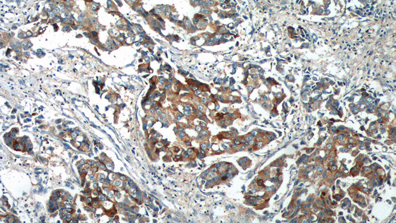Immunohistochemistry of paraffin-embedded human breast cancer tissue slide using Catalog No:114183(PRELID1 Antibody) at dilution of 1:200 (under 10x lens).