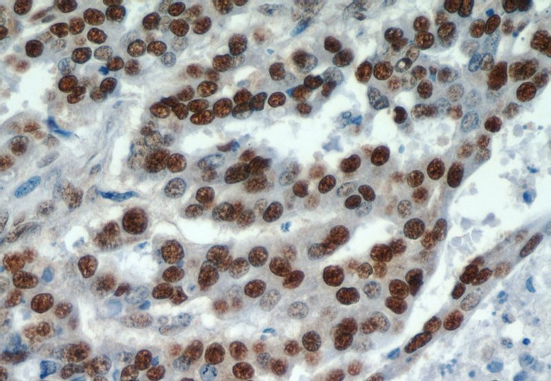 Immunohistochemical of paraffin-embedded human ovary tumor using Catalog No:111386(HDGF antibody) at dilution of 1:100 (under 40x lens)