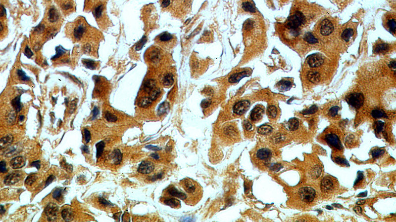 Immunohistochemical of paraffin-embedded human breast cancer using Catalog No:113460(OAS2 antibody) at dilution of 1:50 (under 40x lens)
