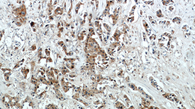 Immunohistochemical of paraffin-embedded human breast cancer using Catalog No:109994(DLK1 antibody) at dilution of 1:50 (under 10x lens)