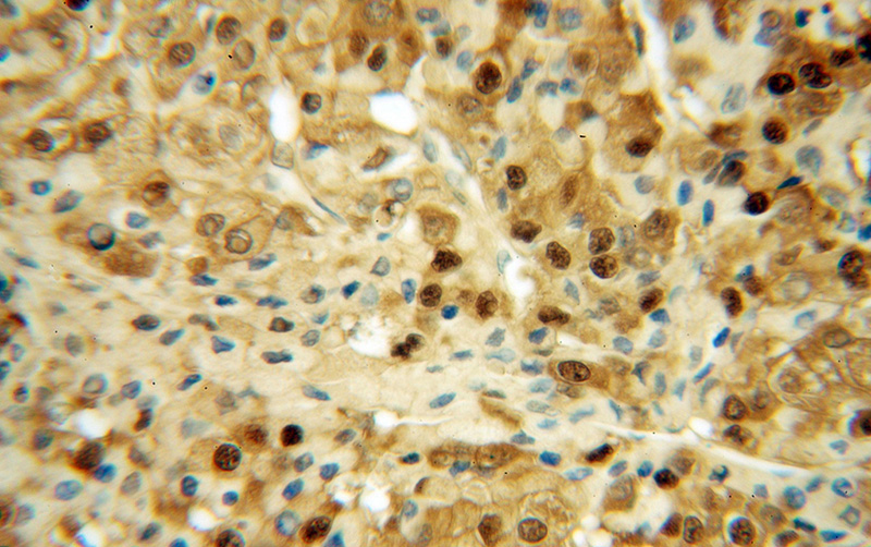 Immunohistochemical of paraffin-embedded human liver cancer using Catalog No:111189(GSTO1 antibody) at dilution of 1:100 (under 40x lens)