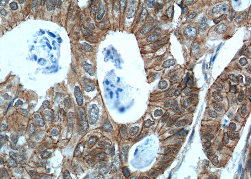 Immunohistochemistry of paraffin-embedded human colon cancer tissue slide using Catalog No:113533(CTNND1 Antibody) at dilution of 1:200 (under 40x lens). heat mediated antigen retrieved with Tris-EDTA buffer(pH9).