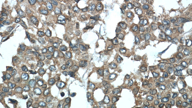 Immunohistochemistry of paraffin-embedded human colon cancer tissue slide using Catalog No:115405(SMURF1 Antibody) at dilution of 1:50 (under 40x lens)