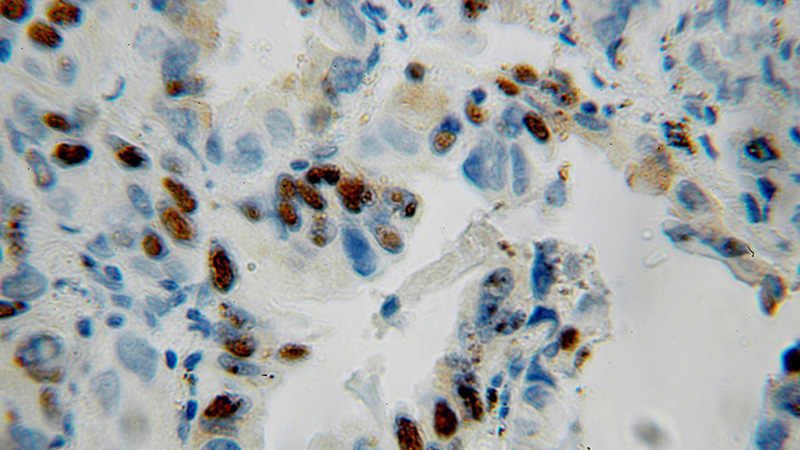 Immunohistochemical of paraffin-embedded human lung cancer using Catalog No:109741(CUL1 antibody) at dilution of 1:50 (under 10x lens)