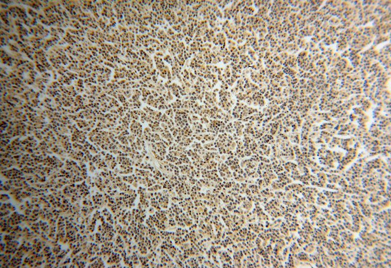 Immunohistochemical of paraffin-embedded human lymphoma using Catalog No:111808(INPP5B antibody) at dilution of 1:50 (under 10x lens)