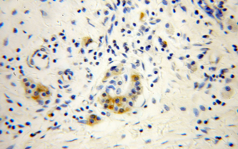Immunohistochemical of paraffin-embedded human pancreas cancer using Catalog No:113225(NPTX2 antibody) at dilution of 1:100 (under 40x lens)