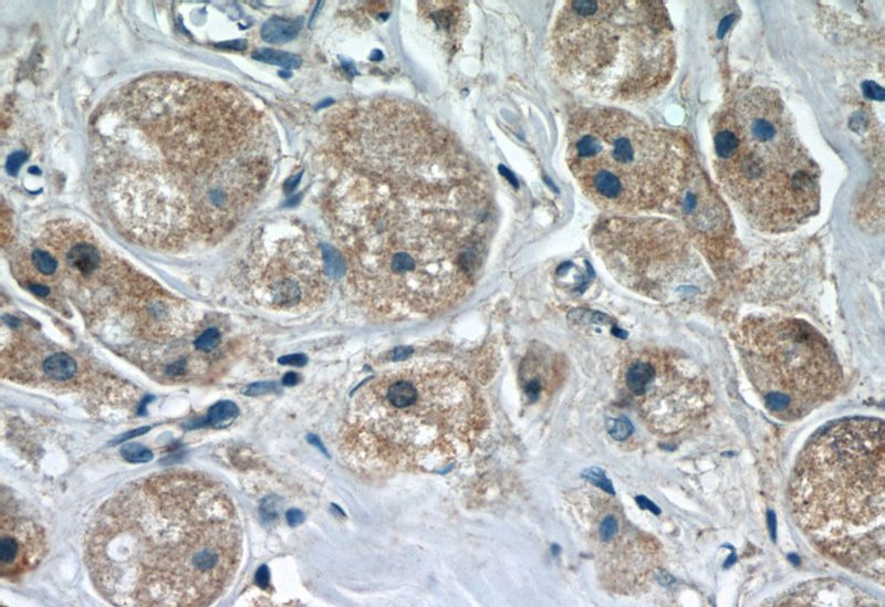 Immunohistochemistry of paraffin-embedded human breast cancer slide using Catalog No:107283(FUT8 Antibody) at dilution of 1:50 under 40x lens