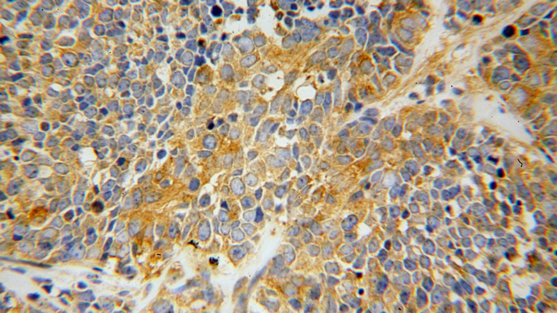 Immunohistochemical of paraffin-embedded human lung cancer using Catalog No:114970(SARS antibody) at dilution of 1:100 (under 40x lens)