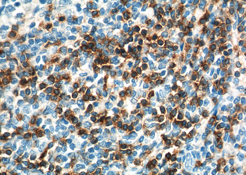 Immunohistochemistry of paraffin-embedded human tonsillitis tissue slide using Catalog No:107142(CD7 Antibody) at dilution of 1:200 (under 40x lens). heat mediated antigen retrieved with Tris-EDTA buffer(pH9).