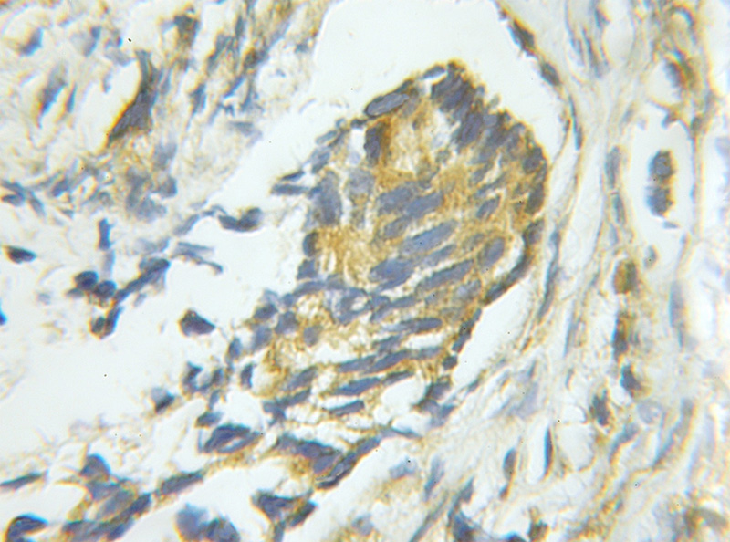 Immunohistochemical of paraffin-embedded human prostate cancer using Catalog No:114310(PTPN1 antibody) at dilution of 1:50 (under 10x lens)