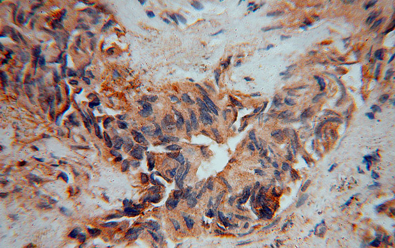 Immunohistochemical of paraffin-embedded human lung cancer using Catalog No:111757(IMMP2L antibody) at dilution of 1:100 (under 40x lens)
