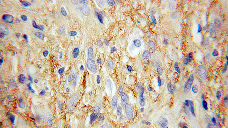 Immunohistochemical of paraffin-embedded human gliomas using Catalog No:110990(GNAO1 antibody) at dilution of 1:100 (under 10x lens)
