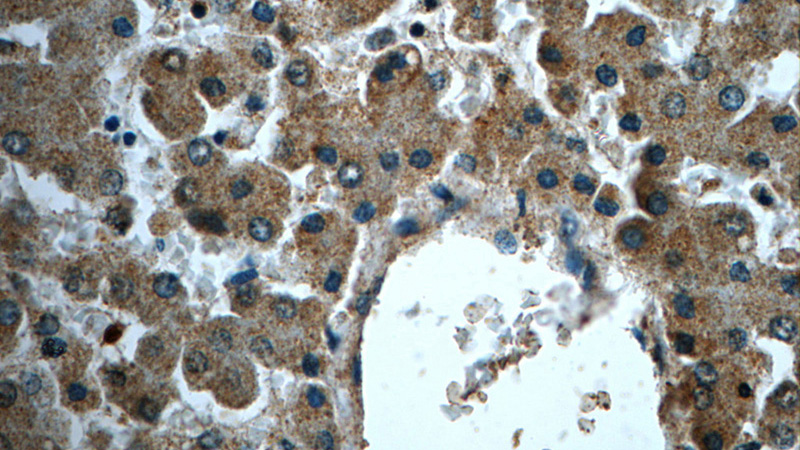 Immunohistochemistry of paraffin-embedded human liver tissue slide using Catalog No:112780(MTIF3 Antibody) at dilution of 1:50 (under 40x lens)