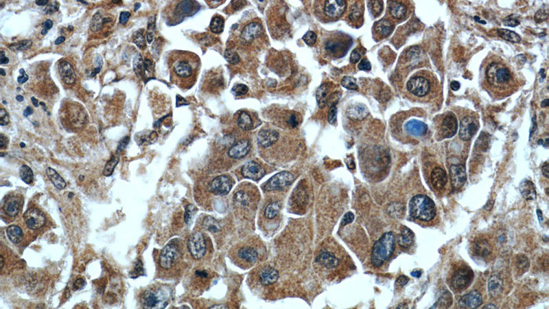 Immunohistochemistry of paraffin-embedded human liver cancer tissue slide using Catalog No:110825(GAGE2D Antibody) at dilution of 1:50 (under 40x lens)