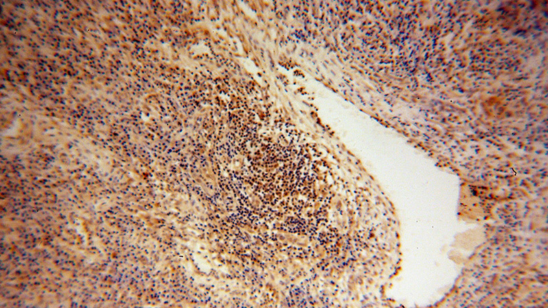 Immunohistochemical of paraffin-embedded human cervical cancer using Catalog No:109093(CDC16 antibody) at dilution of 1:50 (under 10x lens)
